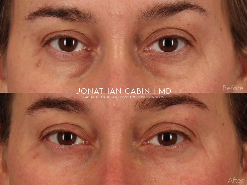 Jonathan Cabin Before and After