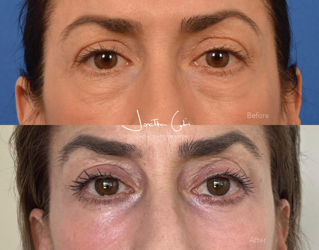 arlington brow lift