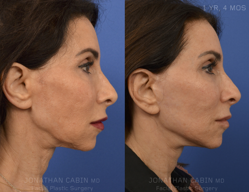 facelift surgery arlington