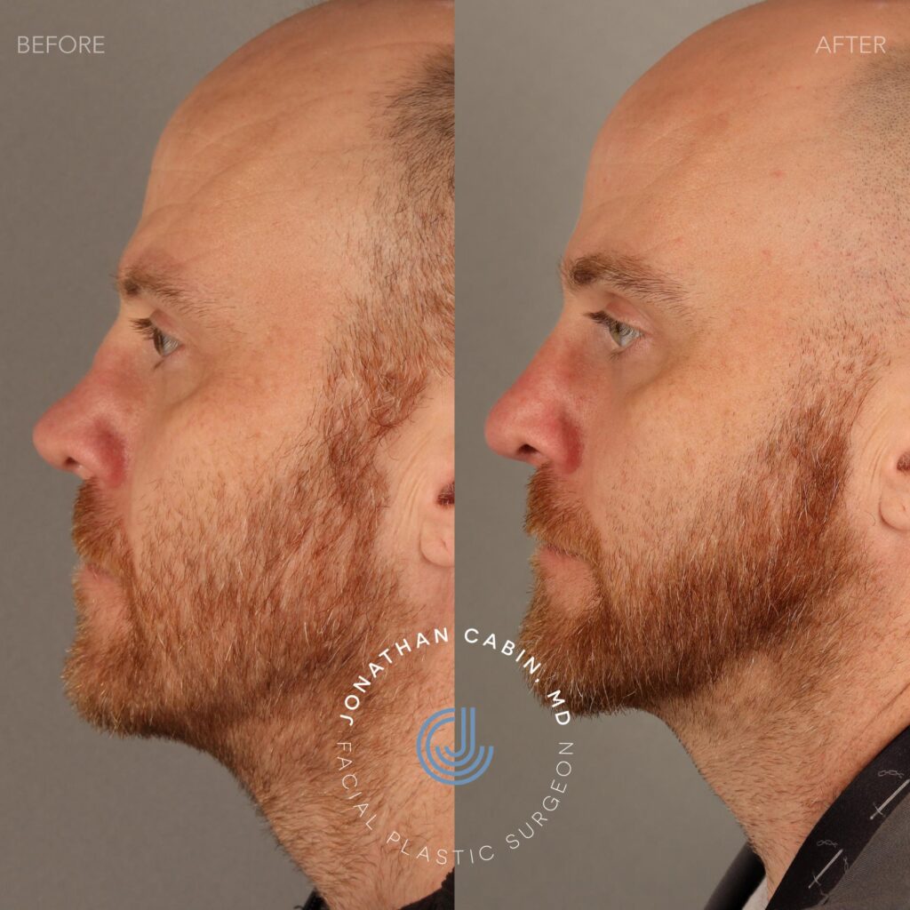 KEBE0120 - Revision Rhinoplasty_Page_4