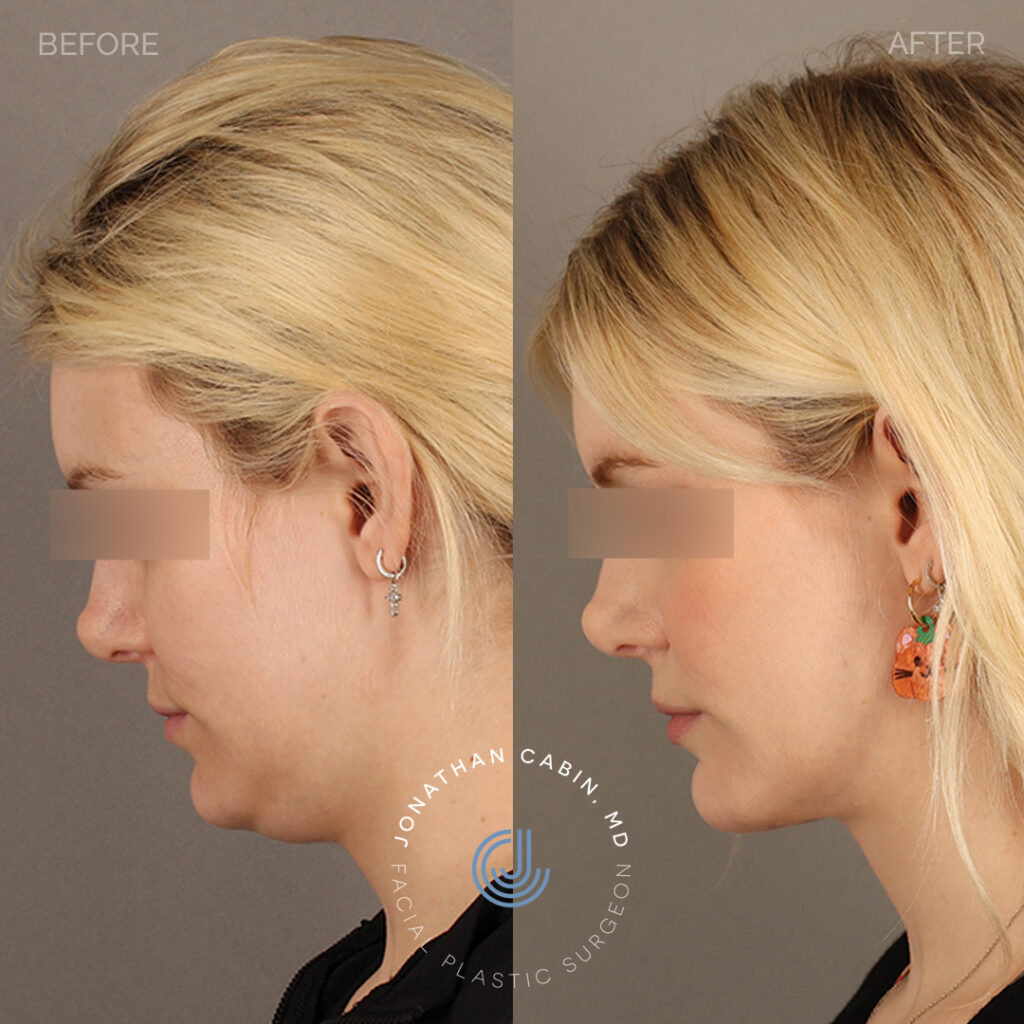 2024-03-18_Jonathan Cabin_73 - Deep Neck Lift Facial Fat Grafting Buccal Fat Reduction - Full Face with Blocked Eyes_L Profile Down_1_GM