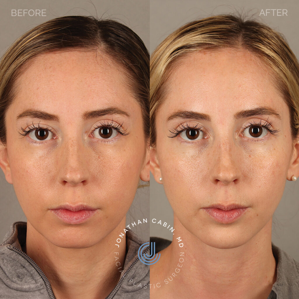 2024-03-19_Jonathan Cabin_74 - Buccal Fat Reduction - Full Face_Front_1_GM