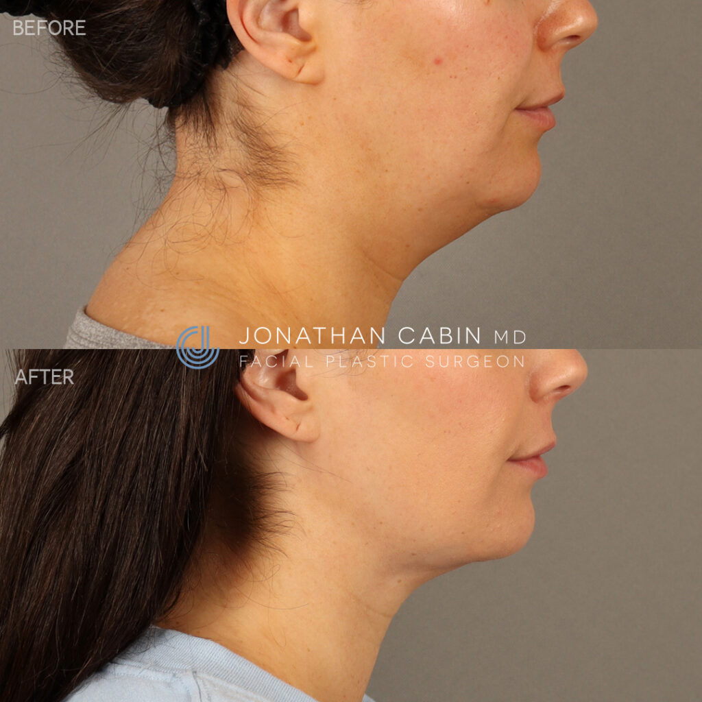 neck lift arlington