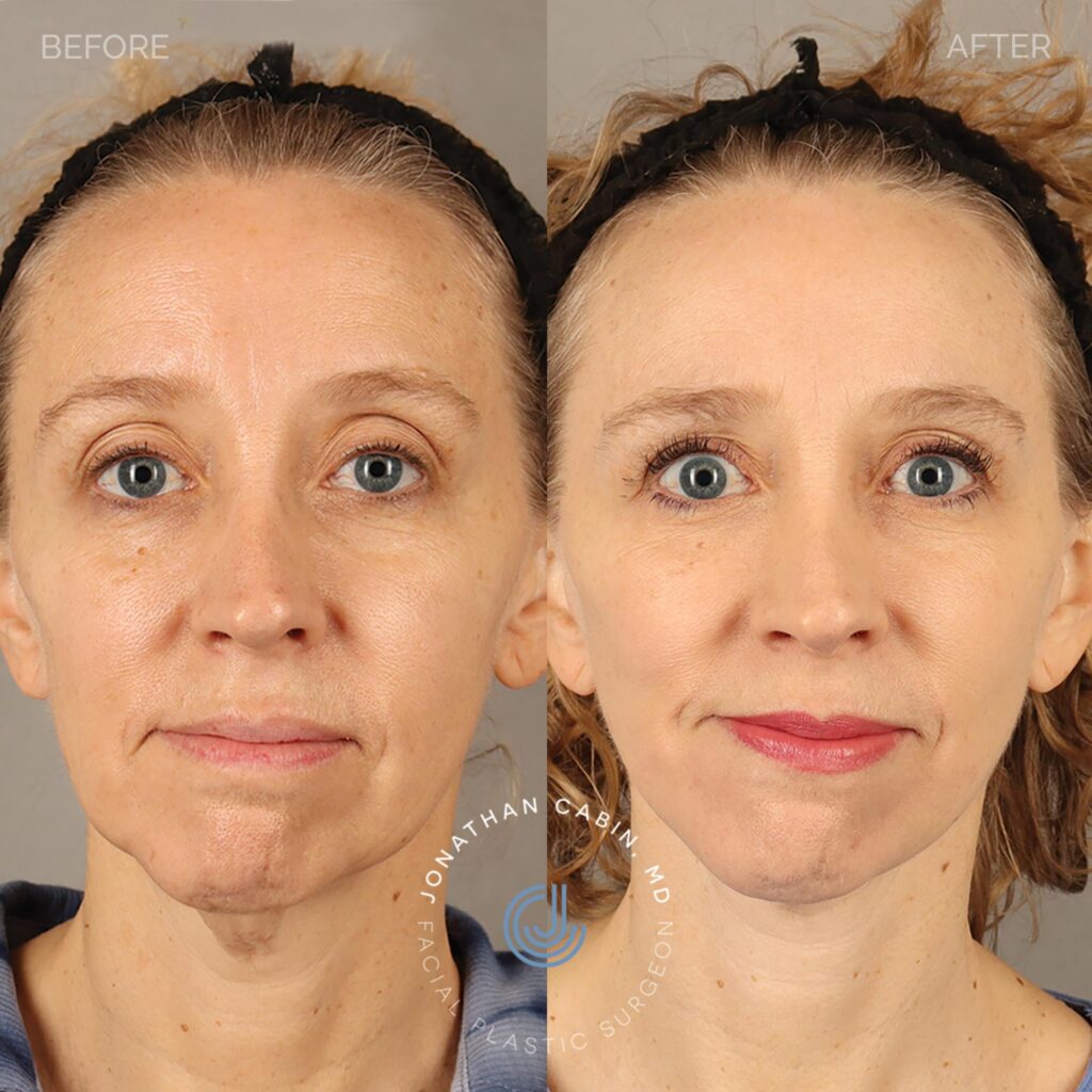 75 - AM - Facelift, Neck Lift, Upper Blepharoplasty - Full Face_7
