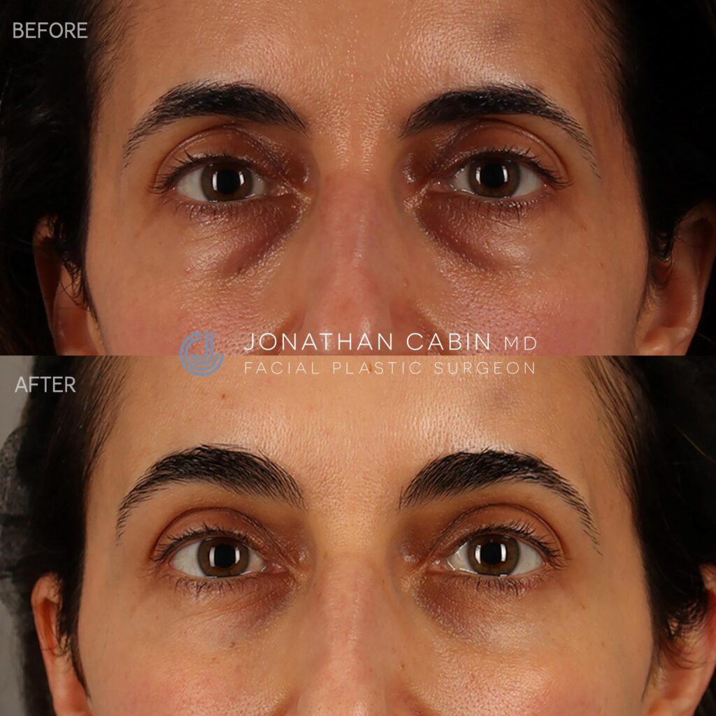 97 - DW - Upper Eyelid Filler (After Lower Bleph) - UPPER FACE_1