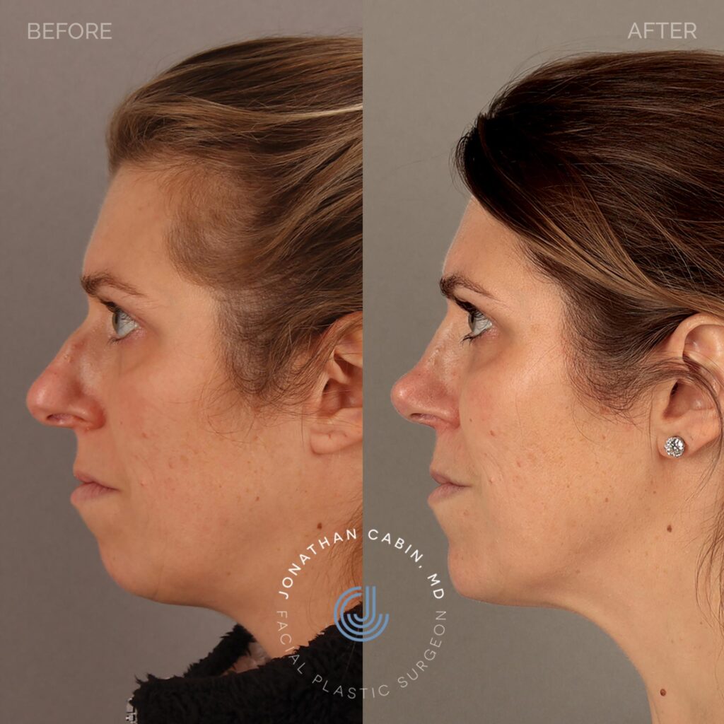 14 - AT - Rhinoplasty, Chin Filler - Full Face_13