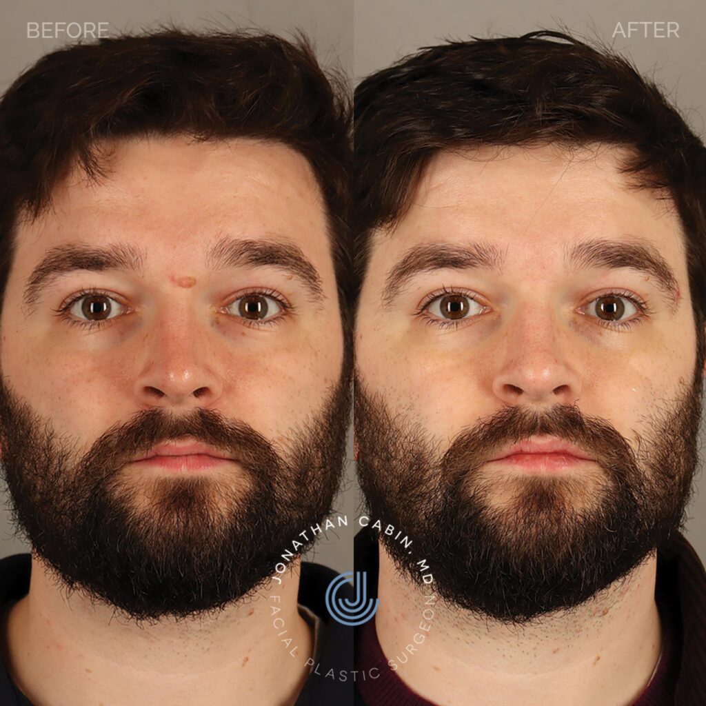 76 - AW - Mole Removal - Full Face_13