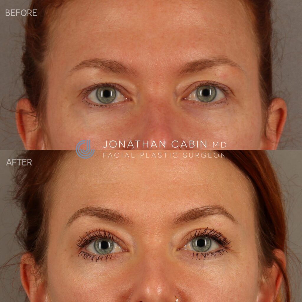 77 - LC - Upper Blepharoplasty - Upper Face Only_1