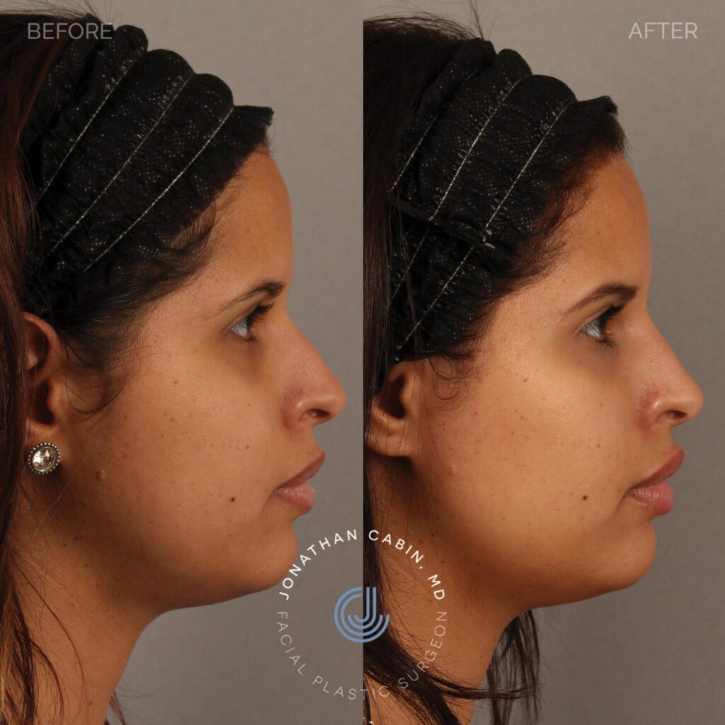 86 - YS - Nonsurgical Rhinoplasty, Lip Filler, Undereye Filler_ FULL Face_1