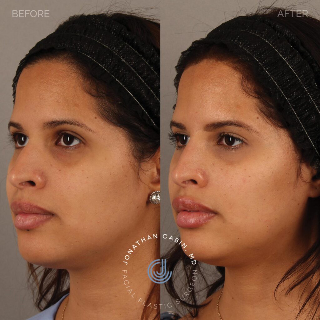 86 - YS - Nonsurgical Rhinoplasty, Lip Filler, Undereye Filler_ FULL Face_10