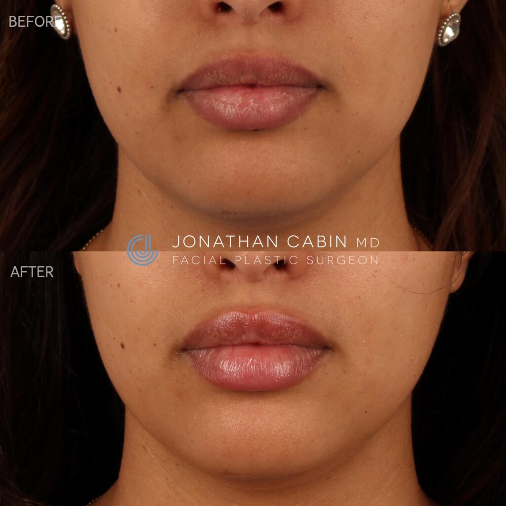 86 - YS - Nonsurgical Rhinoplasty, Lip Filler, Undereye Filler_ LOWER Face_13