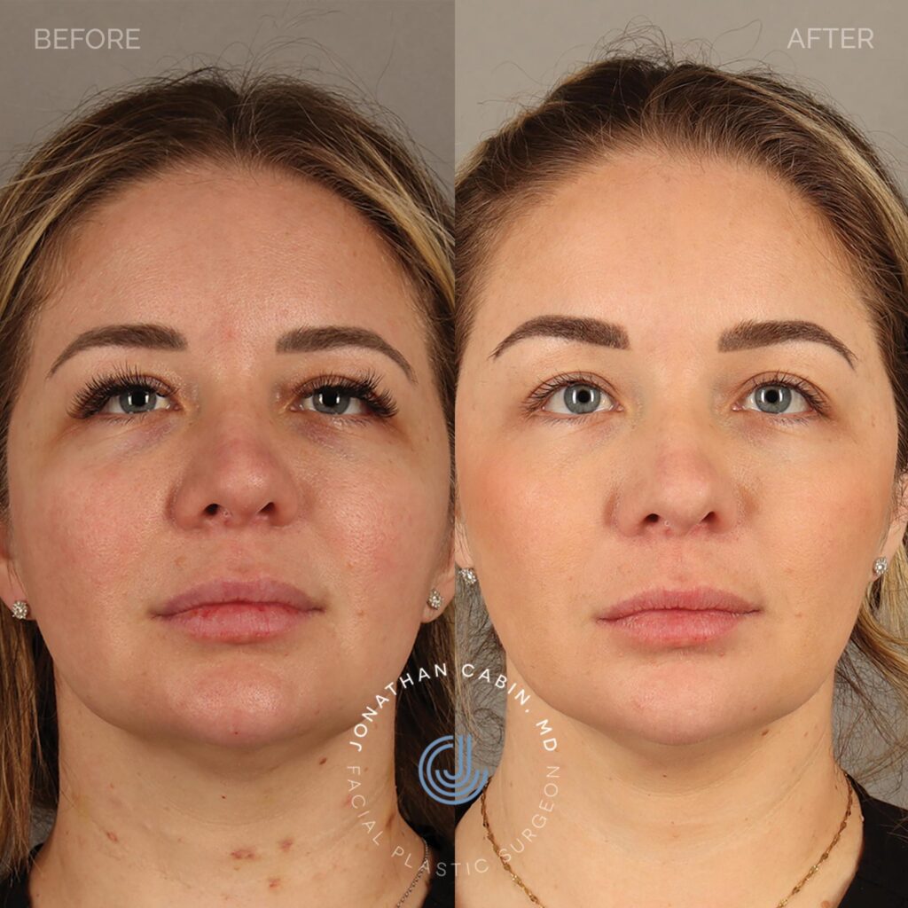 99 - EG - Browlift - FULL FACE_7