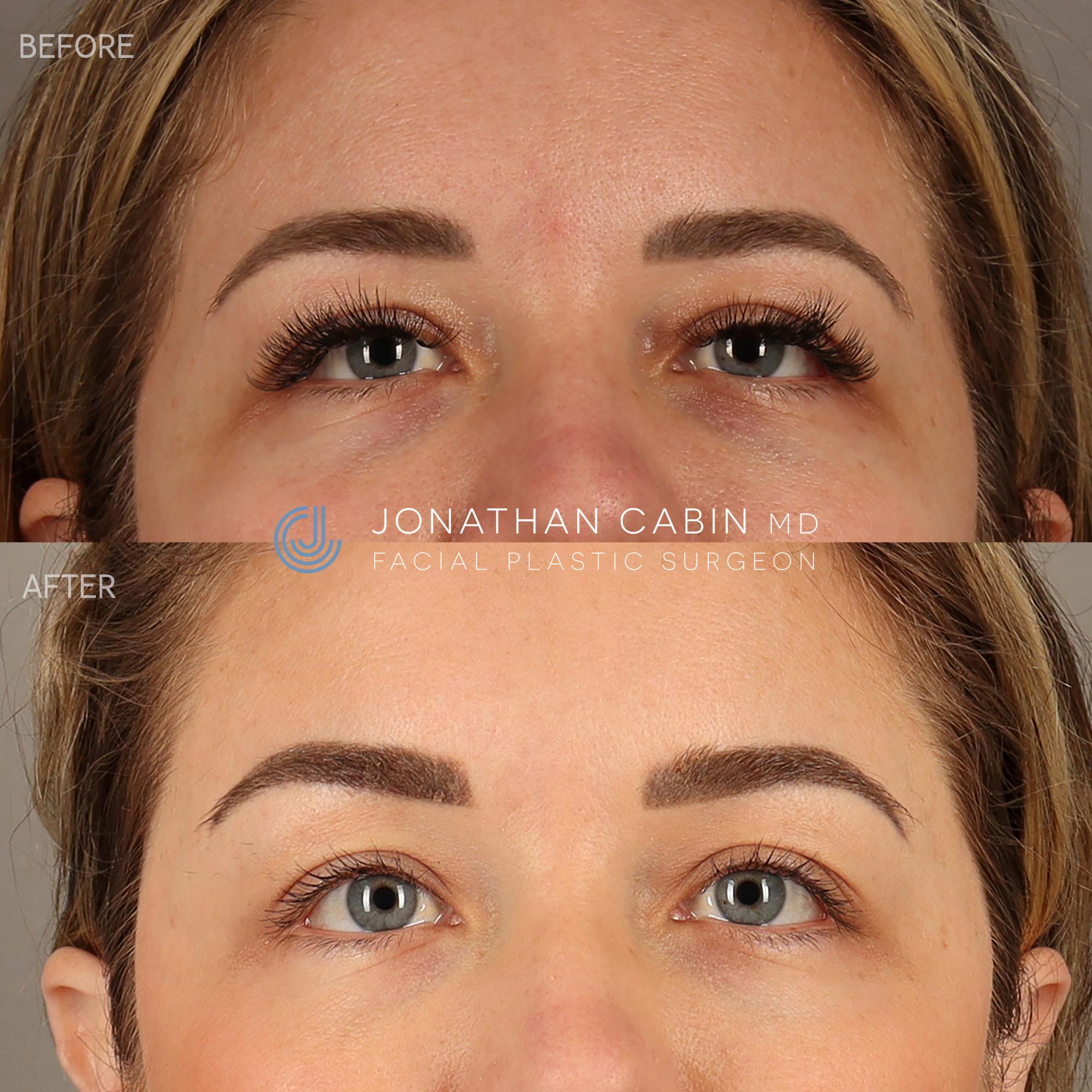 bd5deb372d4b-99___EG___Browlift___UPPER_FACE_ONLY_4-1.jpg