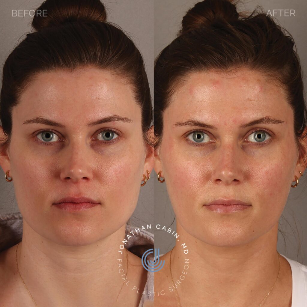 79 - MF - Masseter Botox - No Restrictions_4