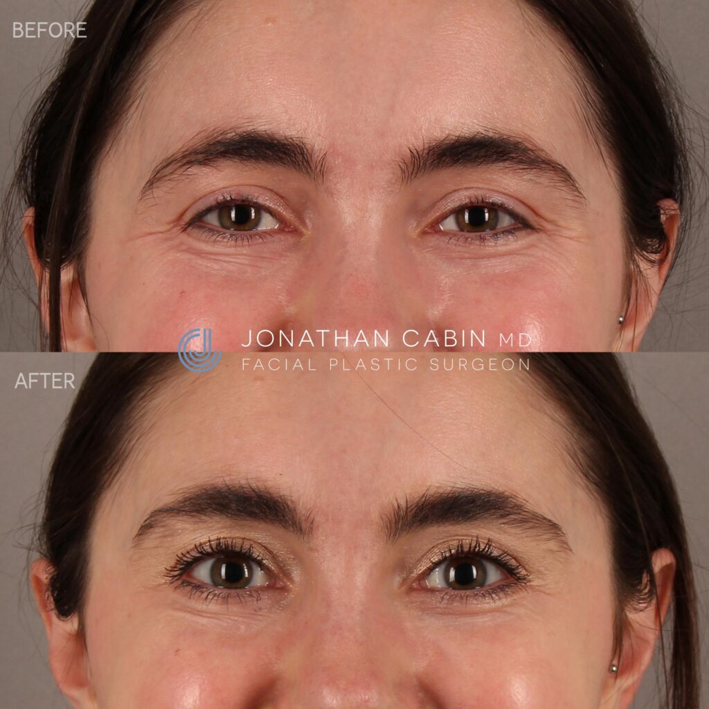 81 - MM - Crows Feet Botox - UPPER FACE ONLY_1
