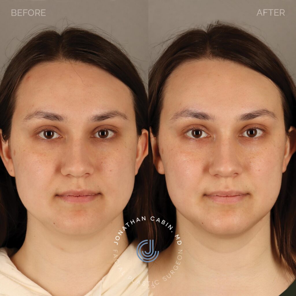 82 - MH - Masseter Botox - Full Face_4