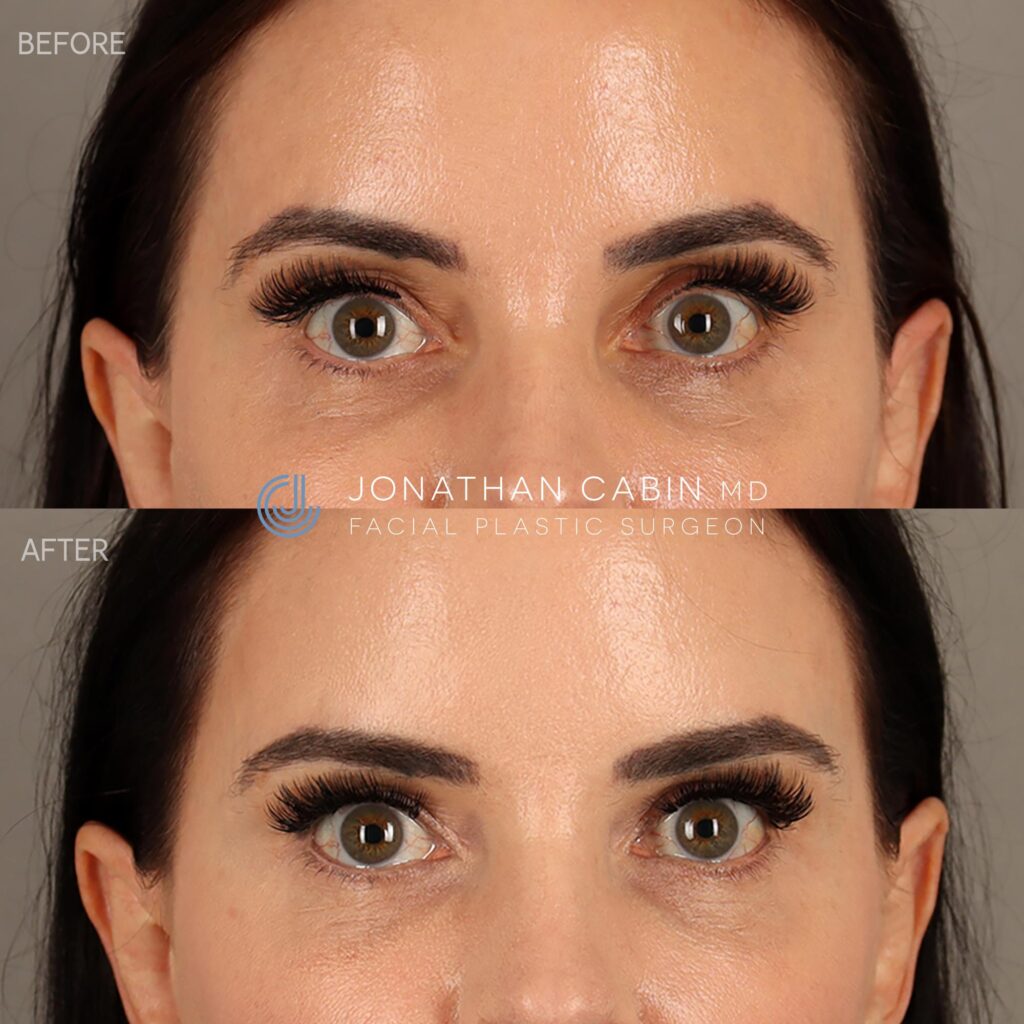 83 - SM - Upper Eyelid Filler - Cropped to Upper Face_4