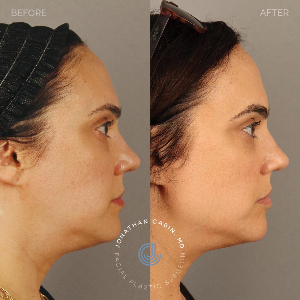88 - EP - Jawline Filler - Full Face_4
