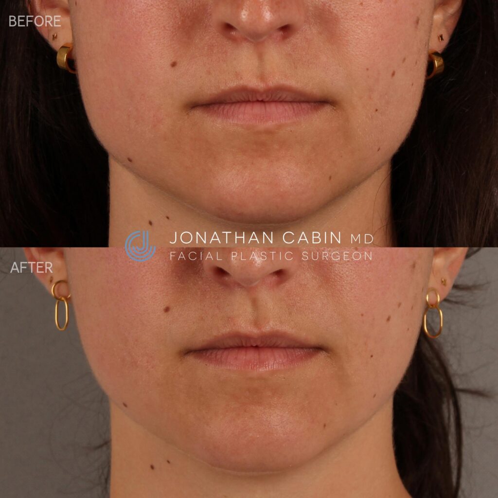 92 - KK - Masseter Botox - LOWER FACE ONLY_1