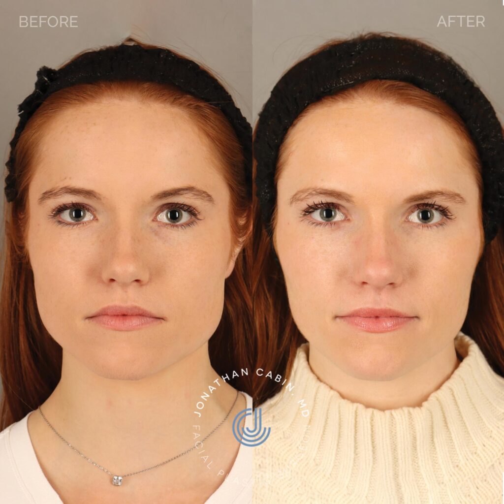 94 - CY - Masseter Botox - No Restrictions_4