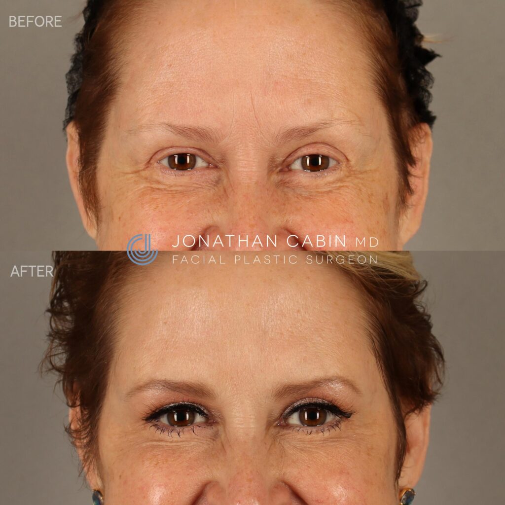 96 - LW - Upper Facial Botox - UPPER FACE_10