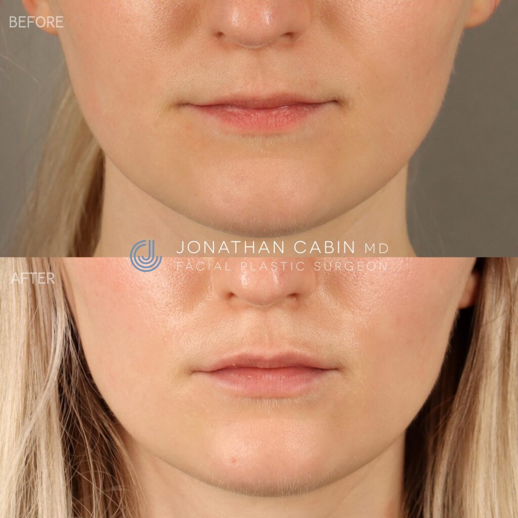 98 - JR - Lip Filler, Masseter Botox - LOWER FACE_1