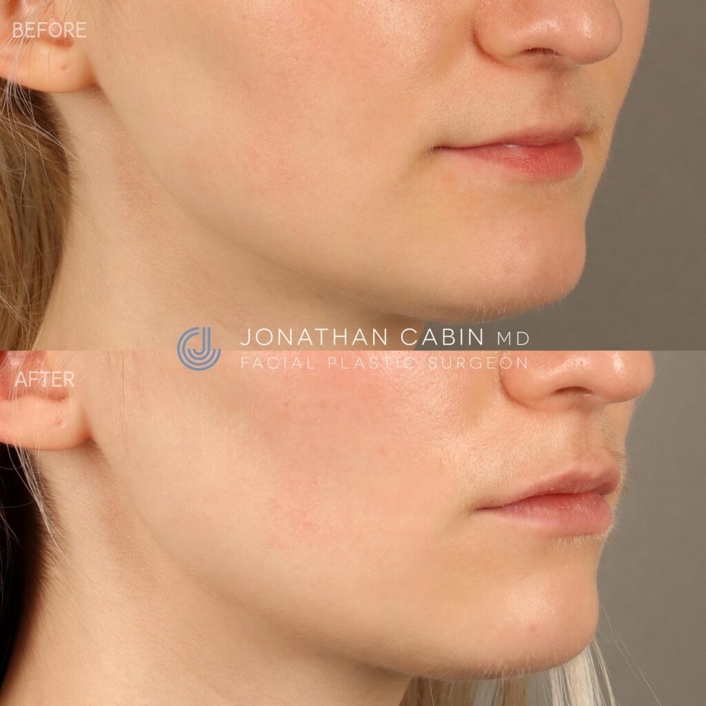 98 - JR - Lip Filler, Masseter Botox - LOWER FACE_10