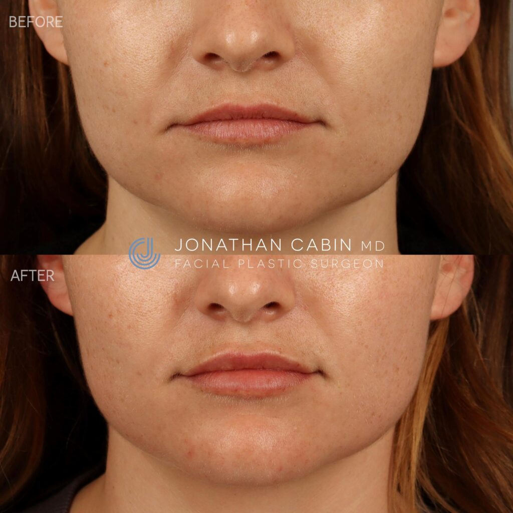 100 - AS - Lip Filler - LOWER FACE_1