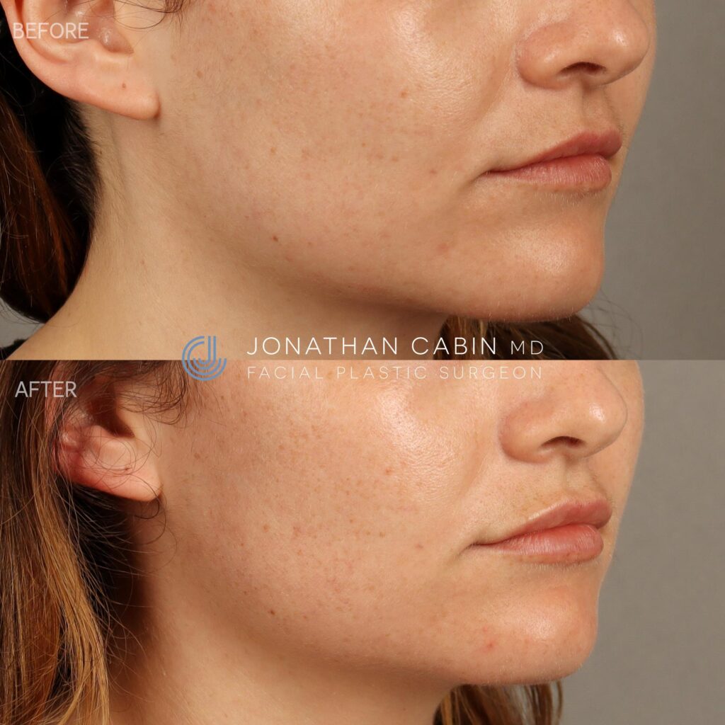 100 - AS - Lip Filler - LOWER FACE_7