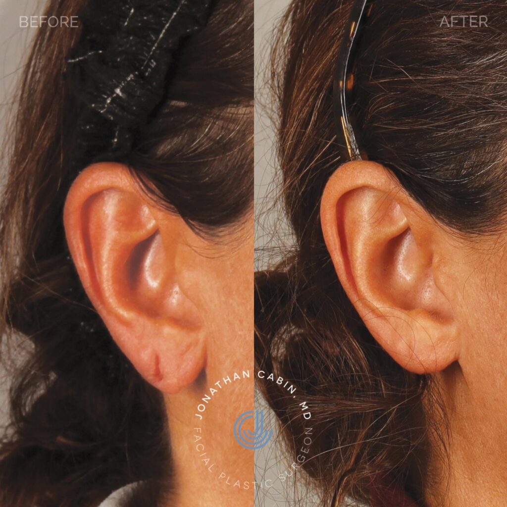 104_EarLobe Repair_CloseUp_3000x3000 _4