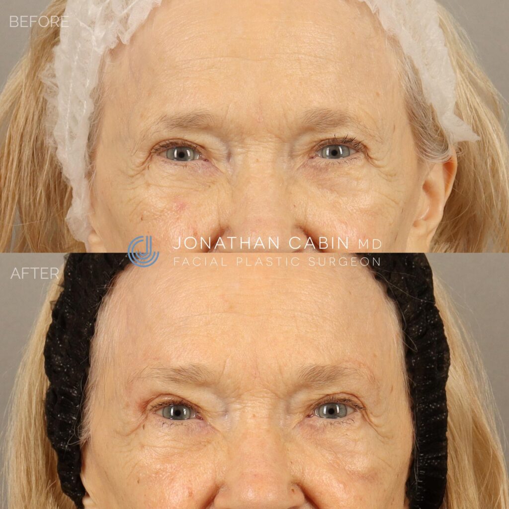 113 - JP - Direct Brow Lift UPPER FACE ONLY_4