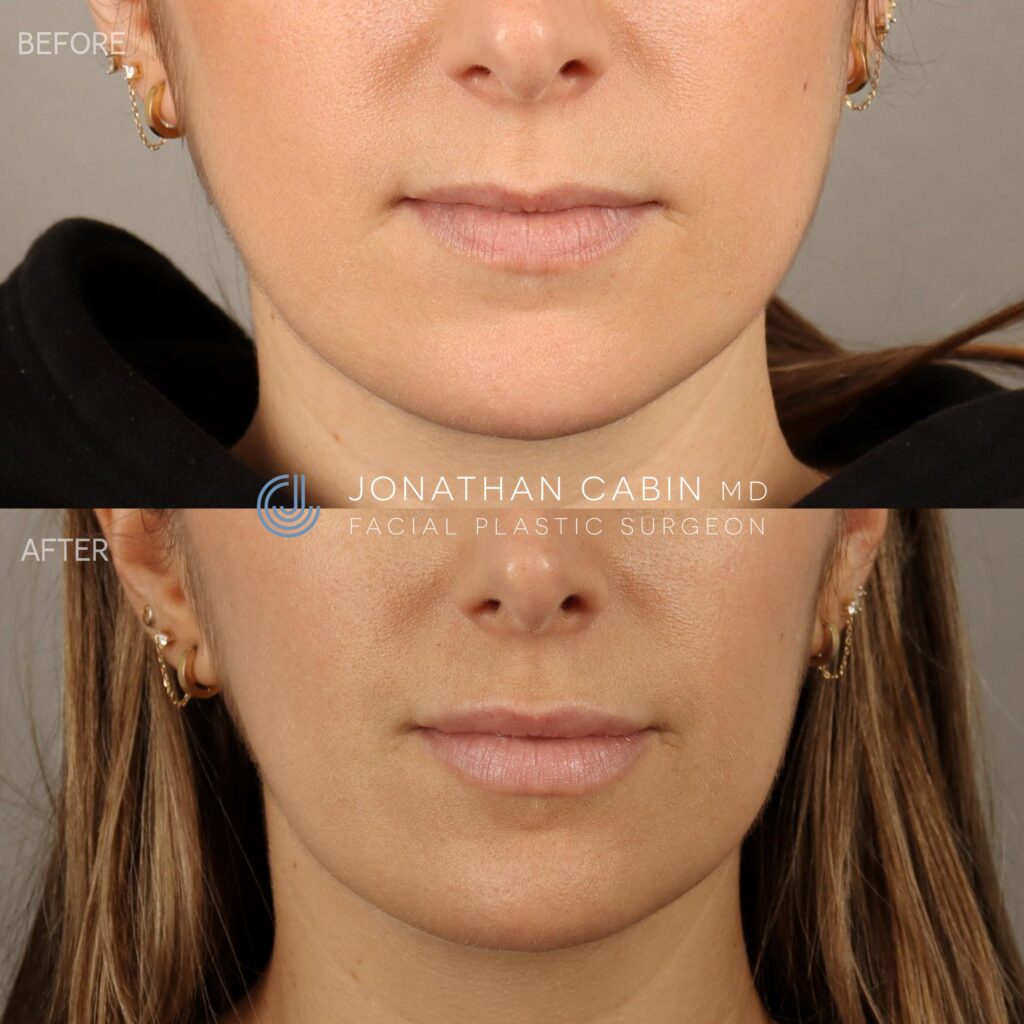 116 - NL - Lip Filler and Masseter Botox Lower Face Only_10