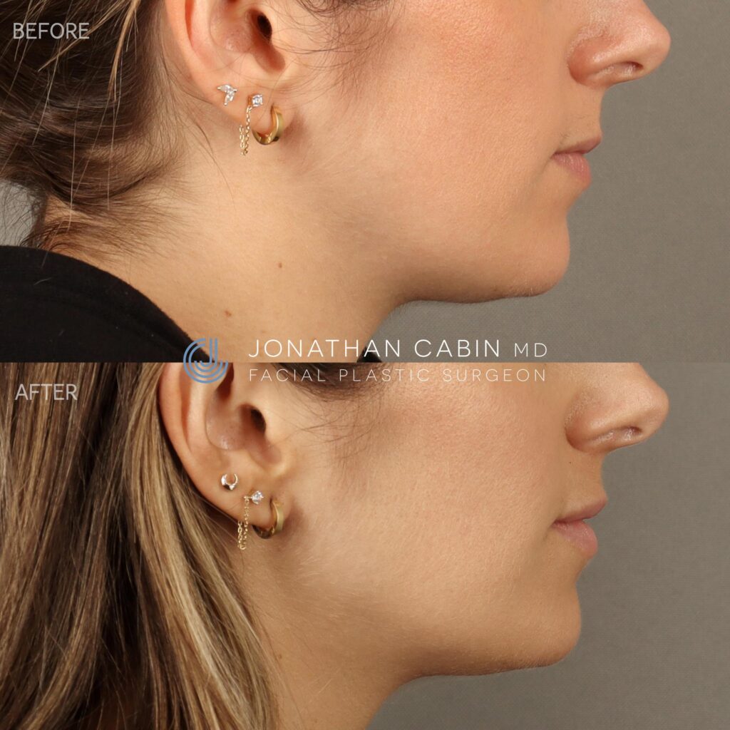 116 - NL - Lip Filler and Masseter Botox Lower Face Only_13