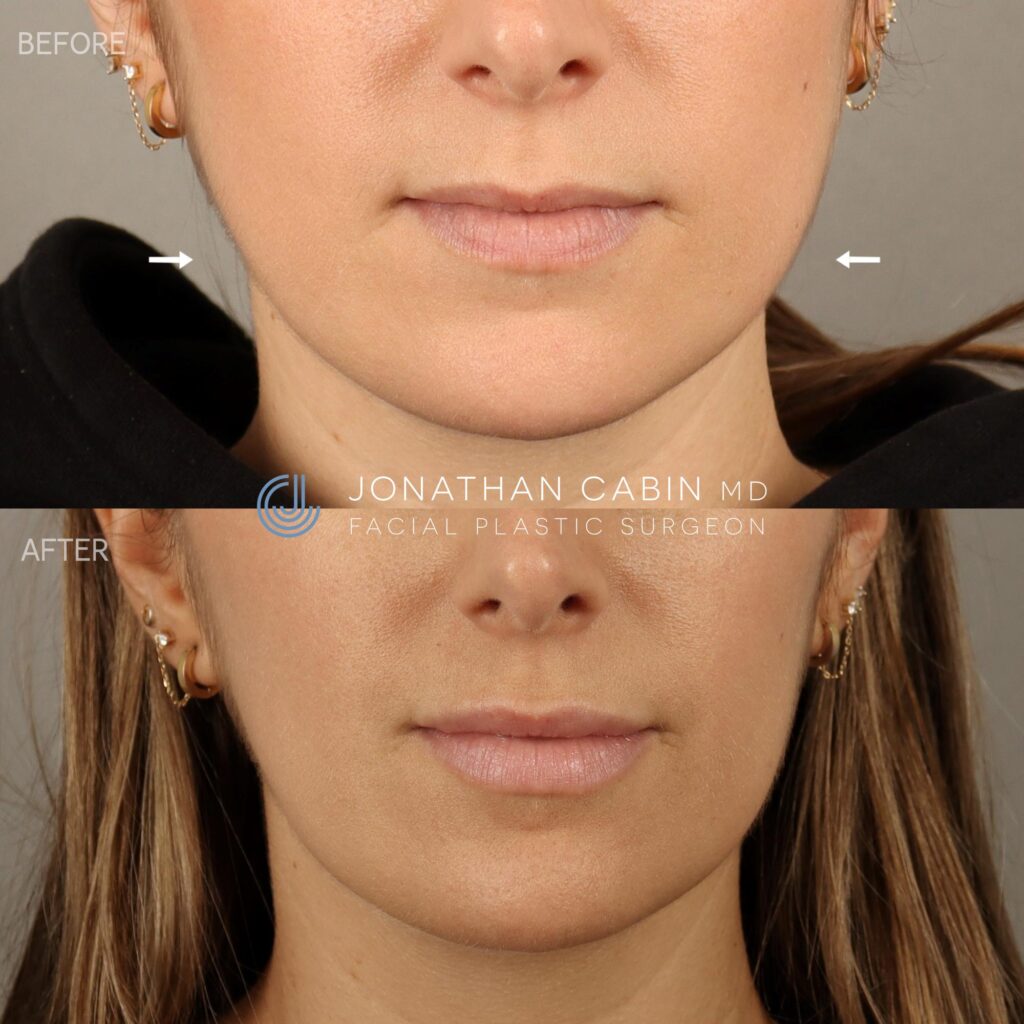 116 - NL - Lip Filler and Masseter Botox Lower Face Only_4