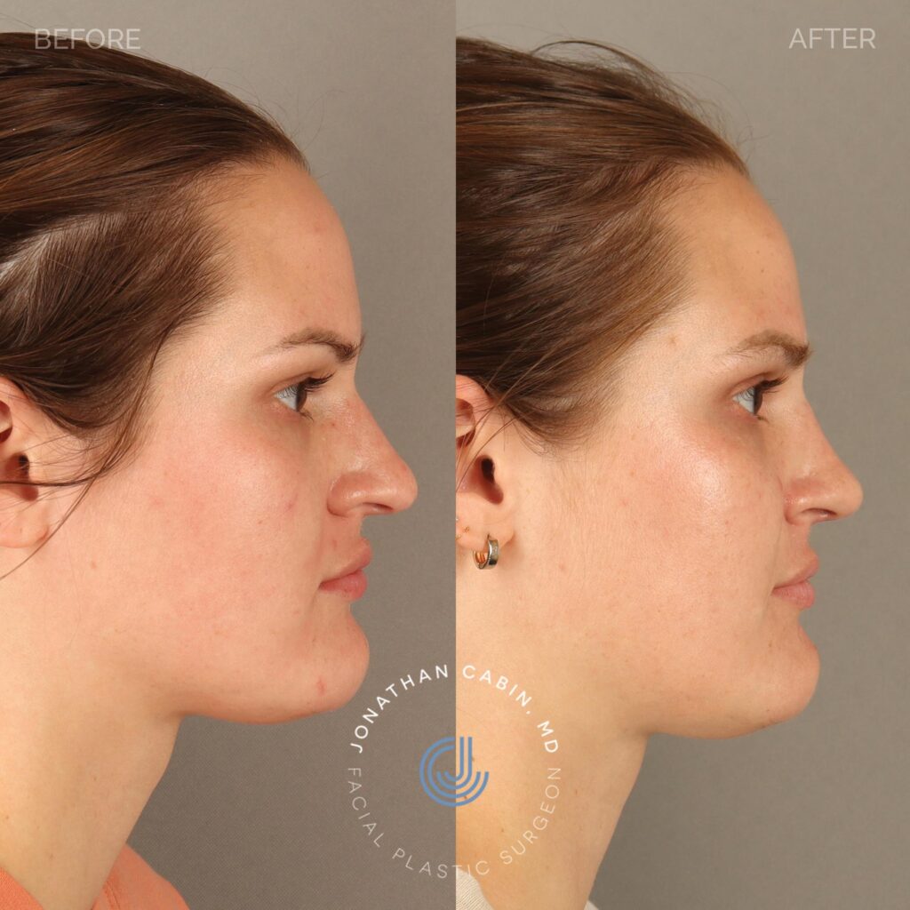 118 - AV - Rhinoplasty_10