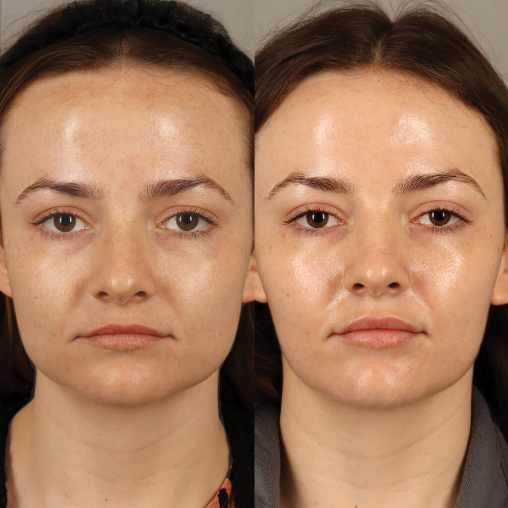 101 - AS - Masseter Botox and Lip Filler - FULL FACE_6