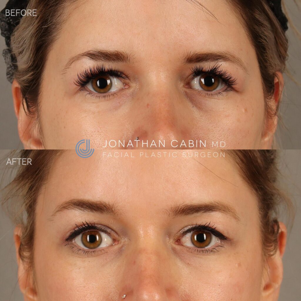 102 - KJ - Revision Upper Blepharoplasty with Browlift - CROPPED TO UPPER FACE_1