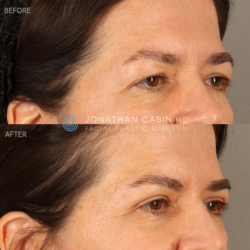 107 - CK - Upper Blepharoplasty, CO2 Laser Around Eyes - CROP TO UPPER FACE_4