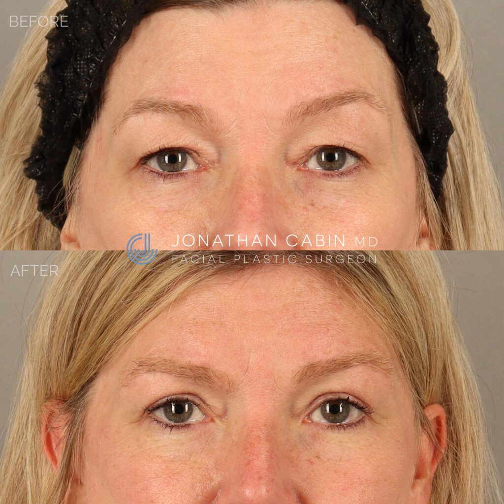 108 - SH - Upper Blepharoplasty Upper Face Only_16