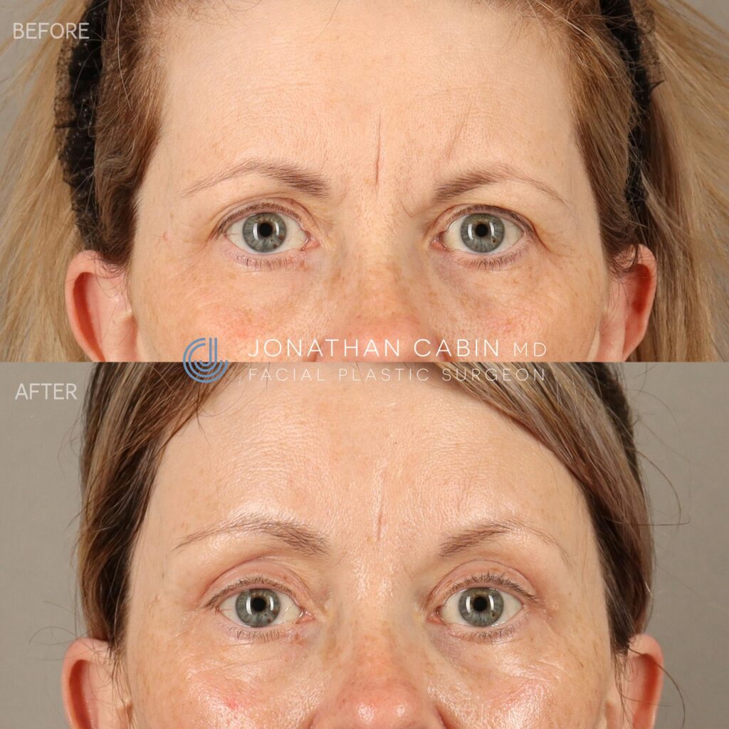 111 - WW - Browlift, Upper Blepharoplasty, CO2 Laser, Earlobe Reduction - UPPER FACE_4