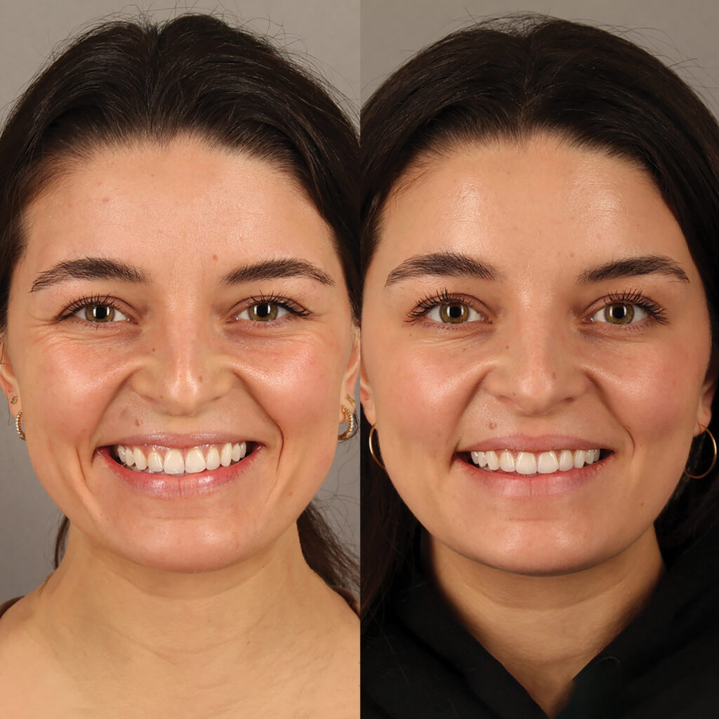 80 - MP - Upper Facial Botox - Full Face_18