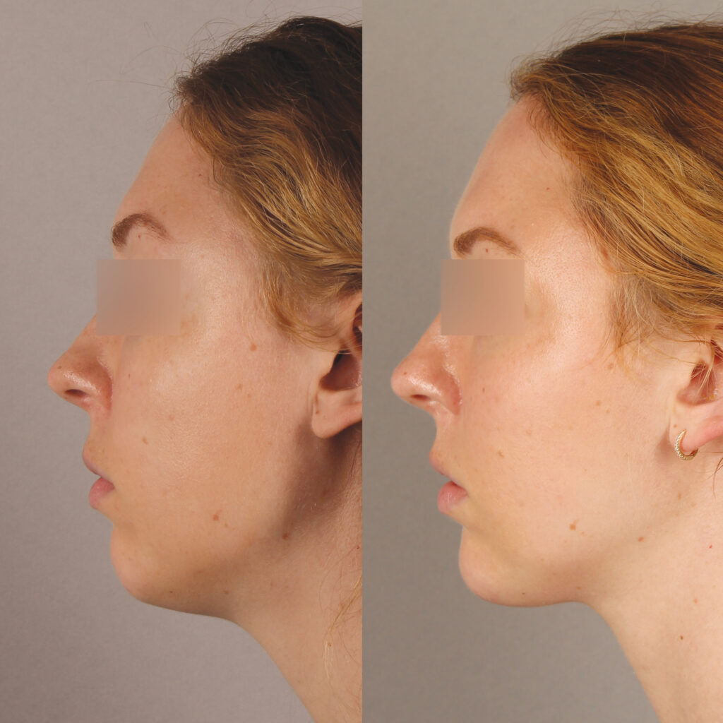 87 - CC - Chin Filler and Masseter Botox - No Restrictions_9