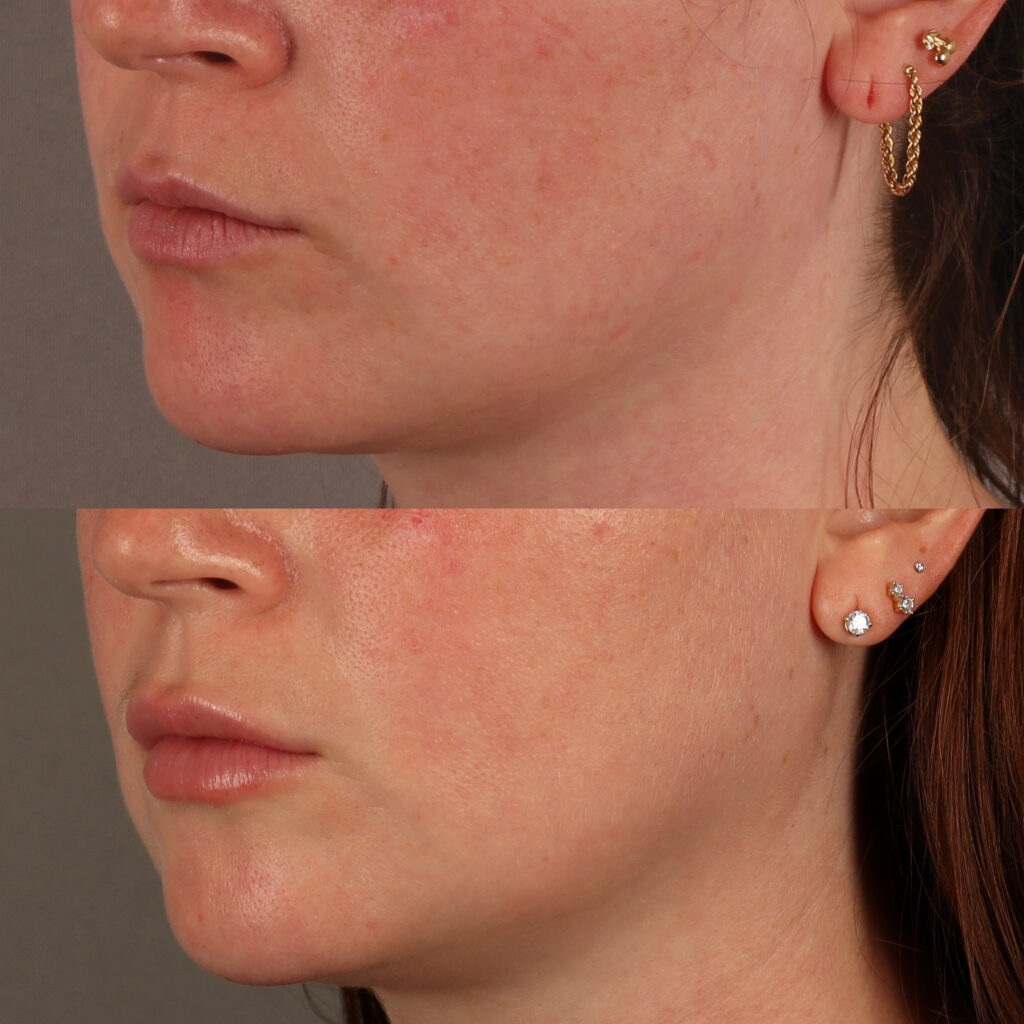 89 - AR - Lip Filler - Lower Face_9
