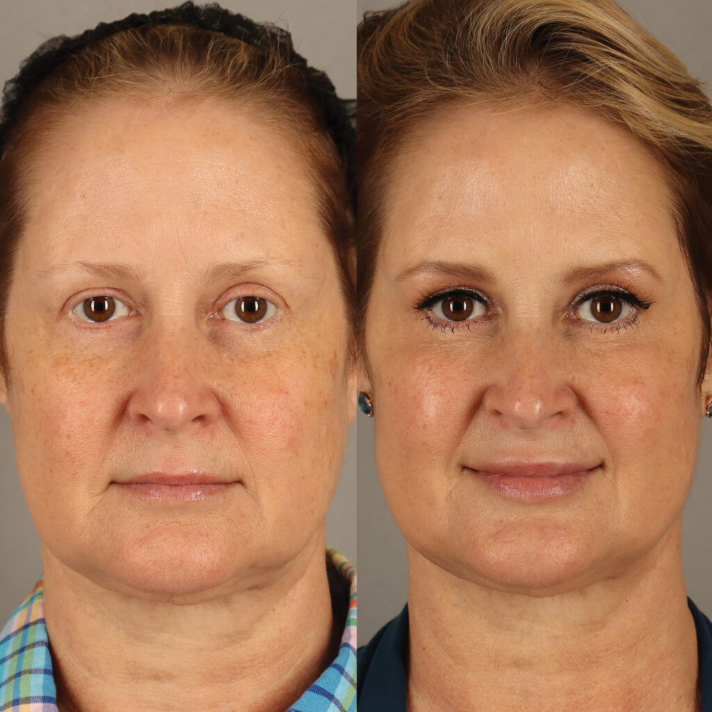 90 - Lip Filler and Cheek Filler - Full Face_3