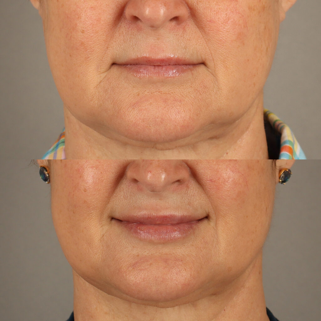 90 - Lip Filler and Cheek Filler - Lower Face_3