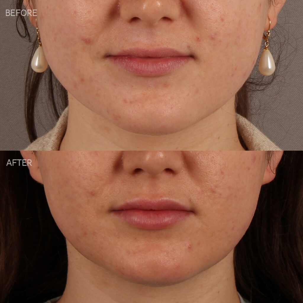 91 -KW - Lip Filler and Masseter Botox - Lower Face_2