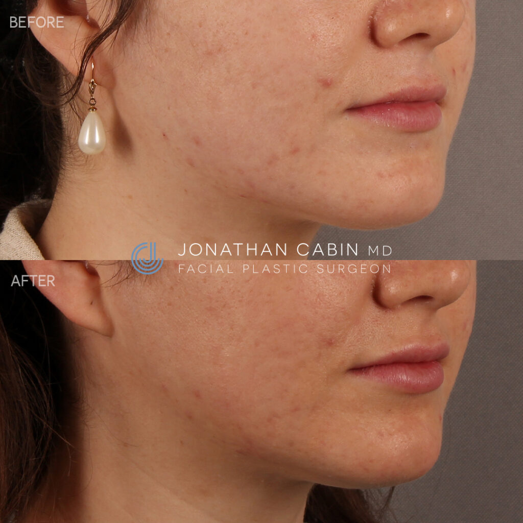 91 -KW - Lip Filler and Masseter Botox - Lower Face_4