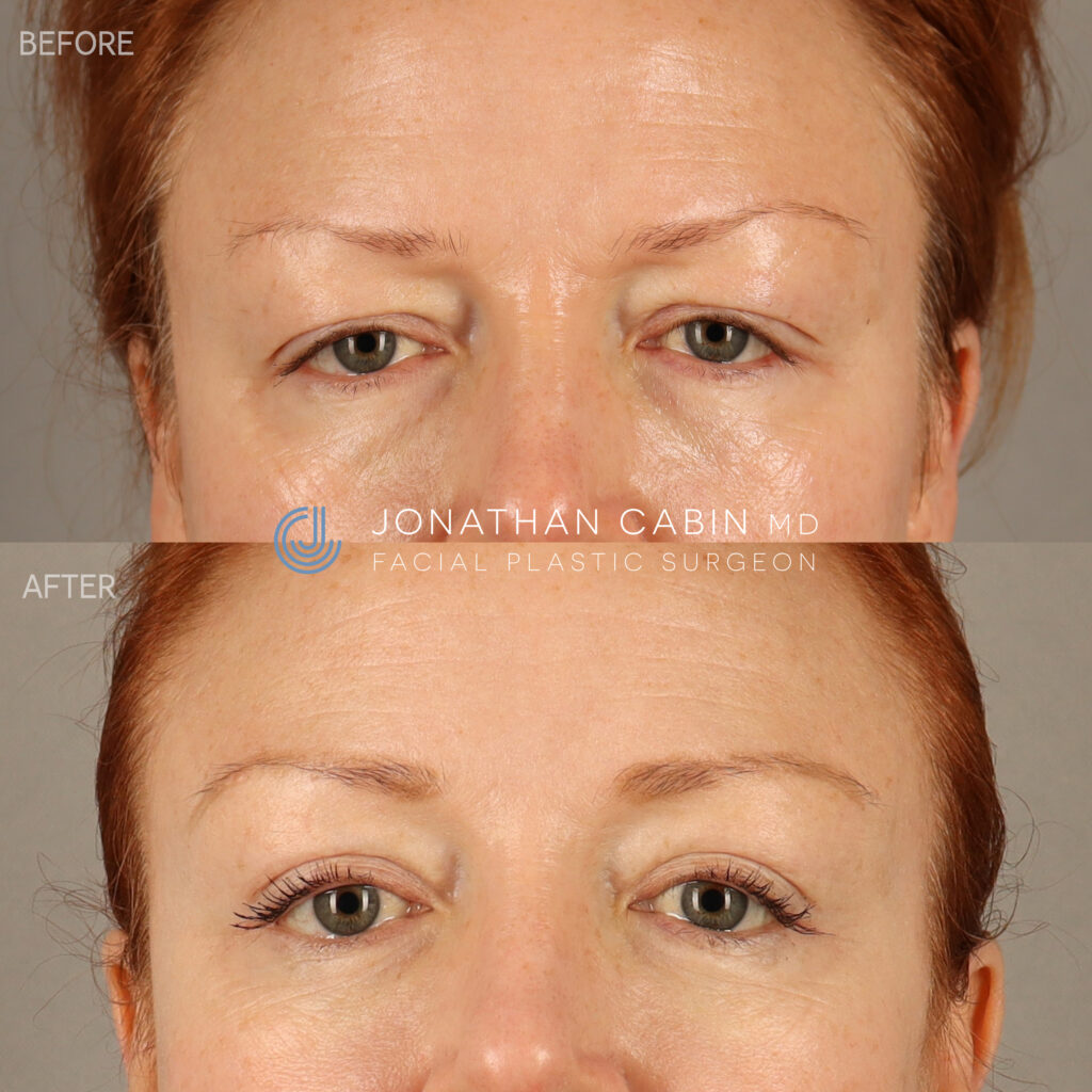 126 - JH - Brow Lift, Upper Bleph, Lower Bleph, Fat Grafting, CO2 Laser UPPER FACE_1