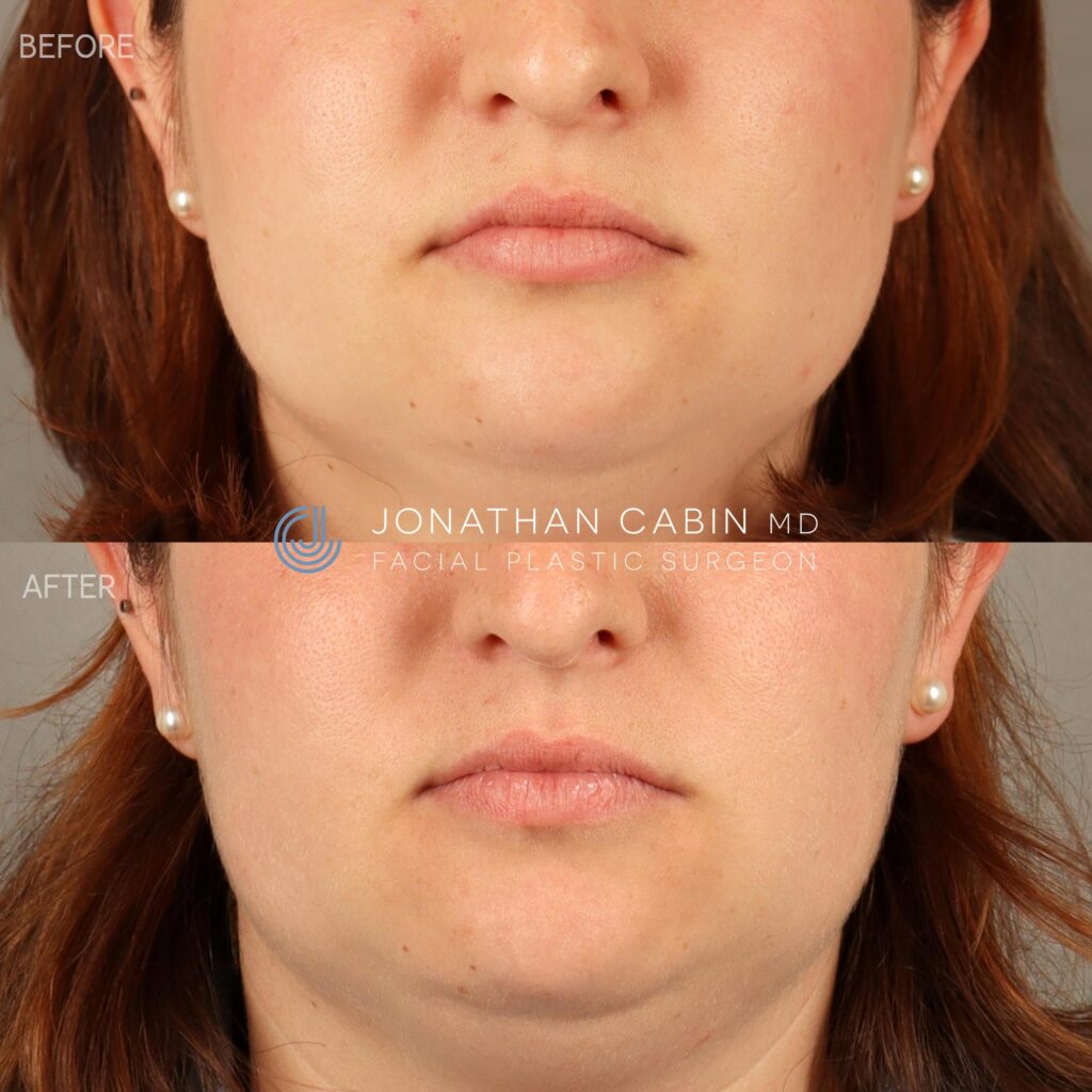 120 - MS - Masseter Botox LOWER FACE ONLY_4