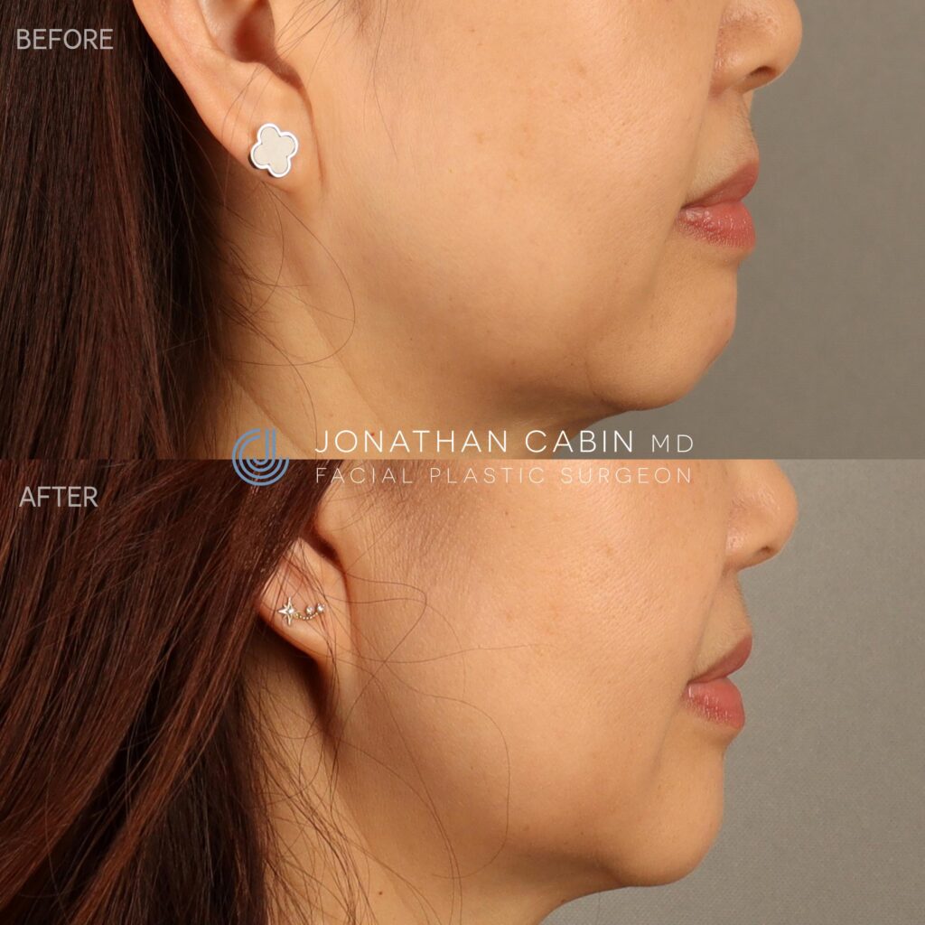 123 - YH4003 - Lower Facial Filler LOWER FACE_4